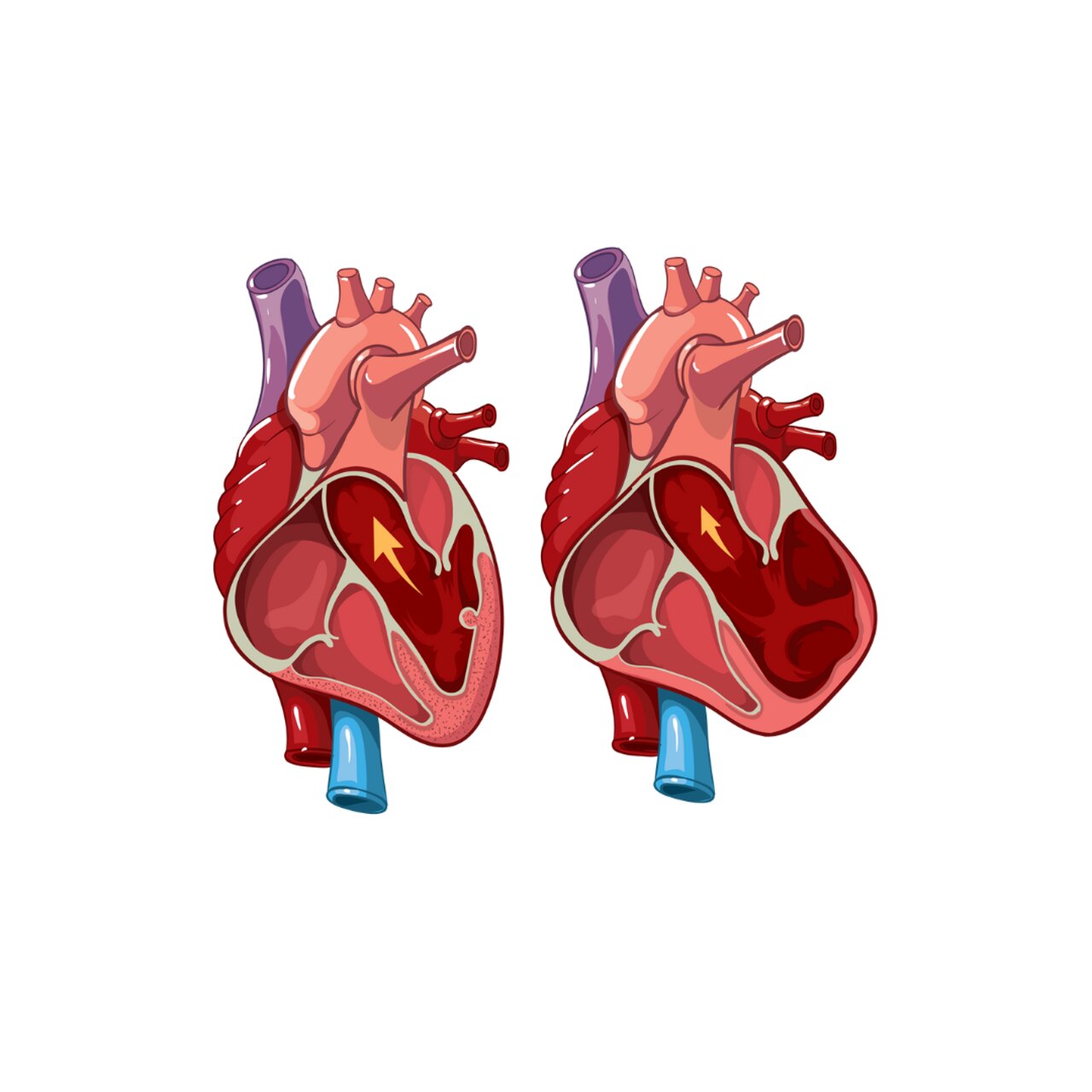 Aneurismas de aorta - Cirurgia Cardíaca Goiana