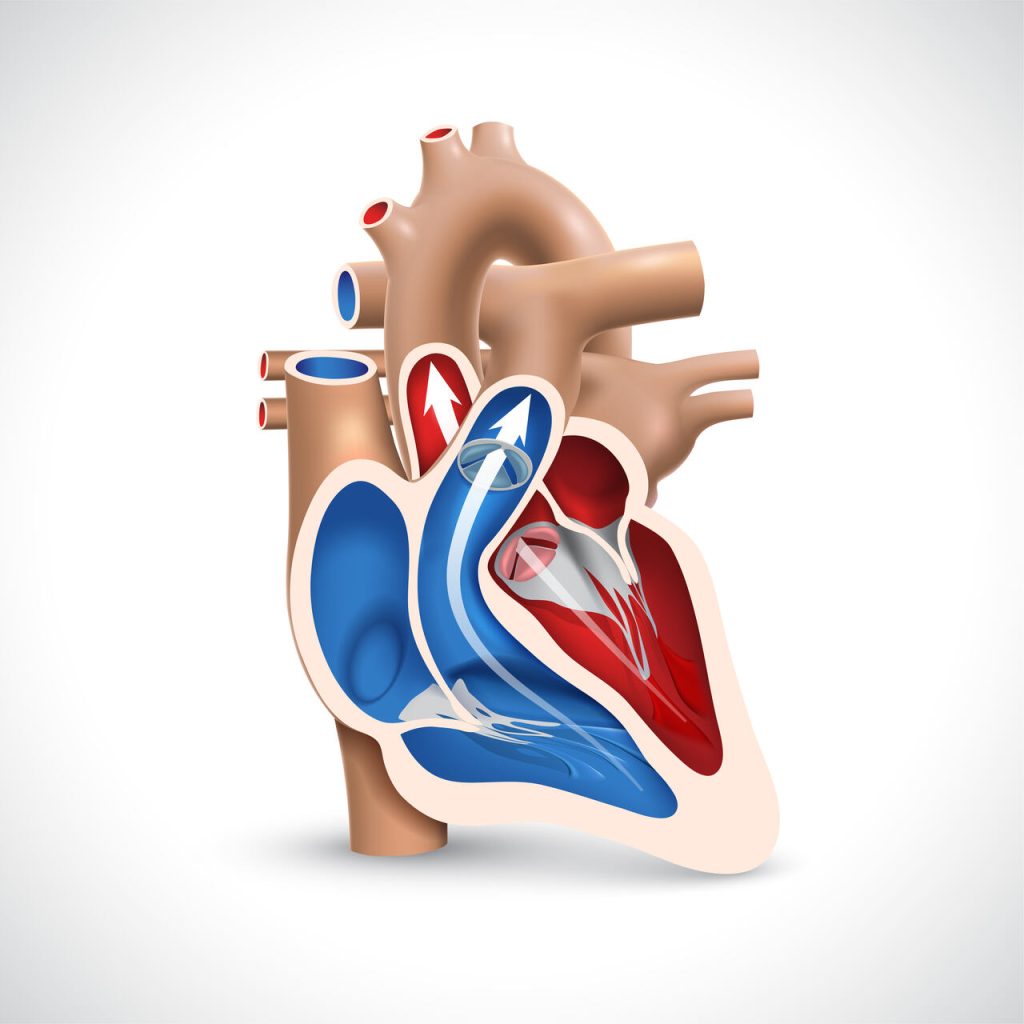 Defeito do septo atrioventricular (DSVA) -Cirurgia Cardíaca Goiana