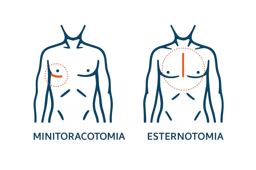 Por que a minitoracotomia está ganhando espaço na cirurgia cardíaca moderna