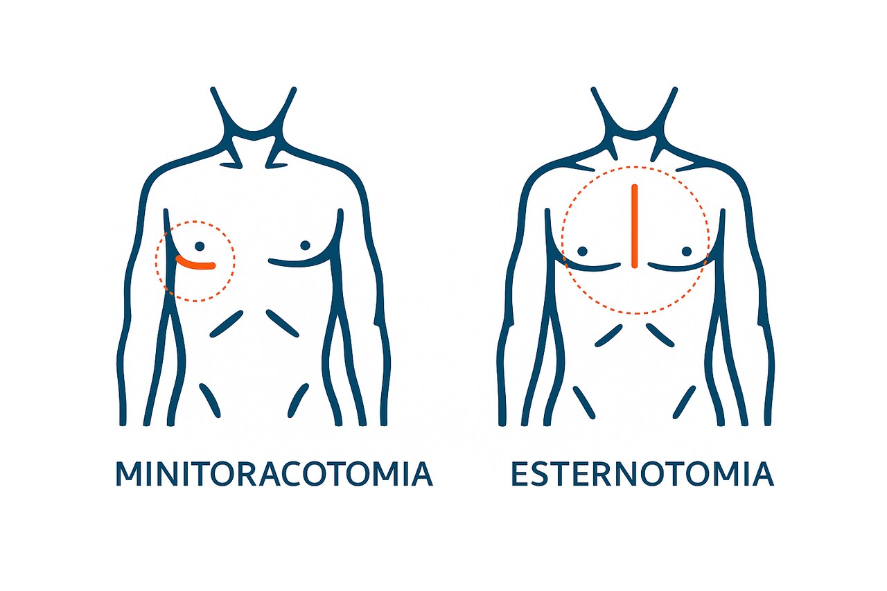 Por que a minitoracotomia está ganhando espaço na cirurgia cardíaca moderna