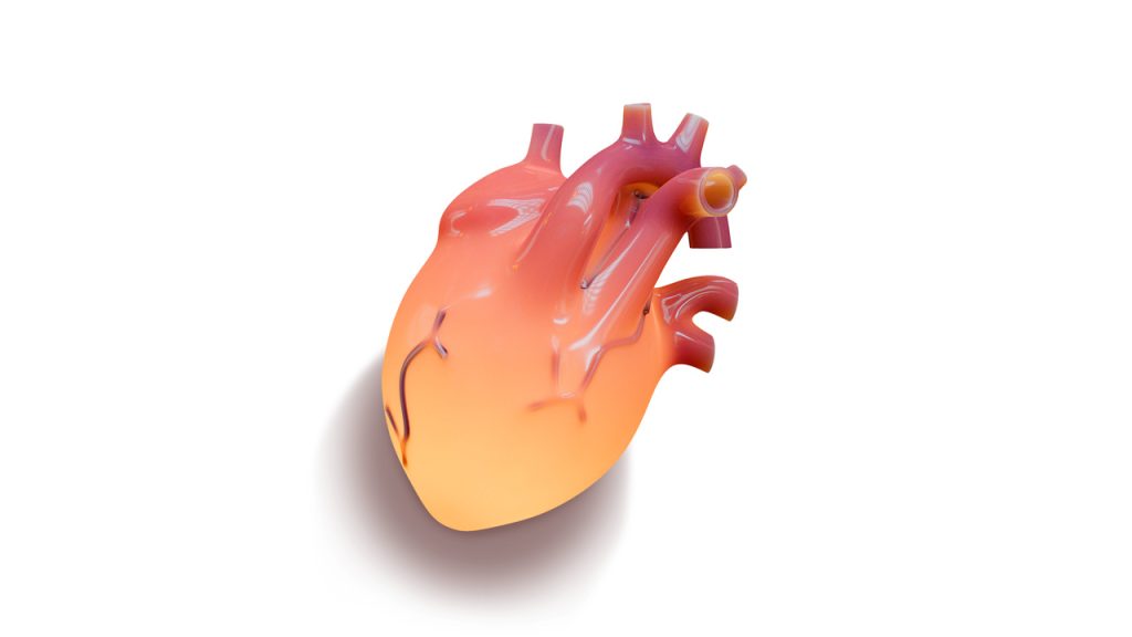 Cirurgia cardíaca congênita avança com planejamento personalizado e impressão